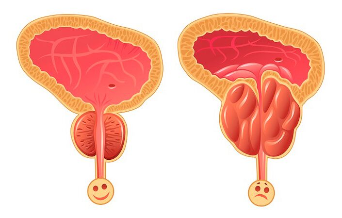 Próstata normal e inflamada.