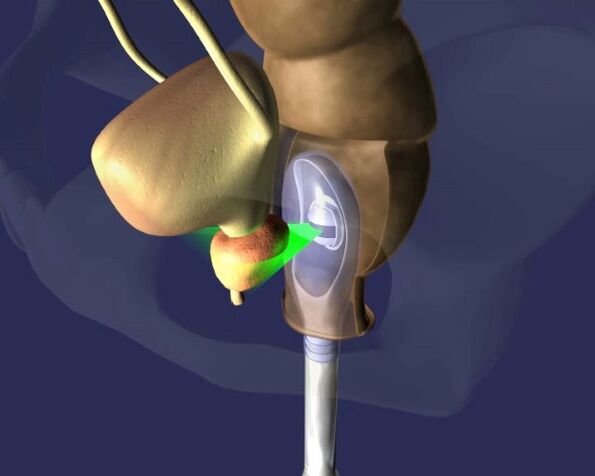 tratamiento de ultrasonido de la próstata para la prostatitis