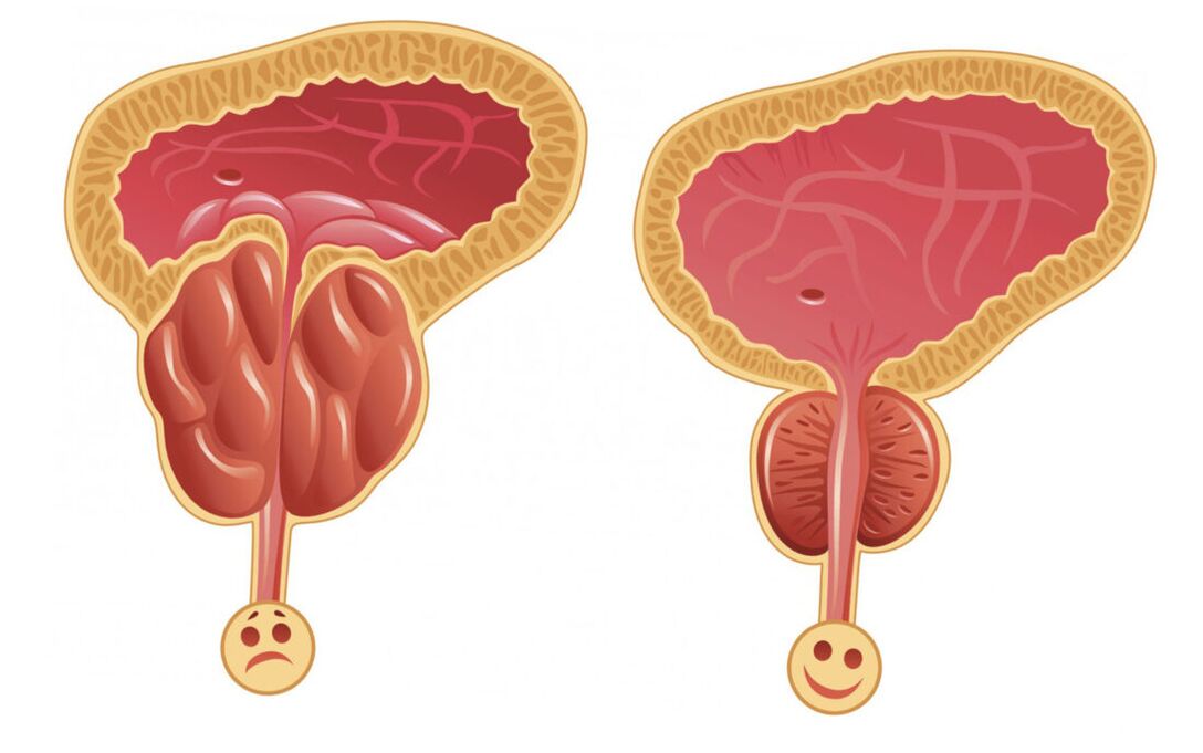 Inflamación de la próstata con prostatitis (izquierda) y la próstata es normal (derecha)