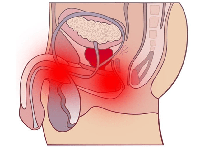 inflamación del tracto genital con prostatitis