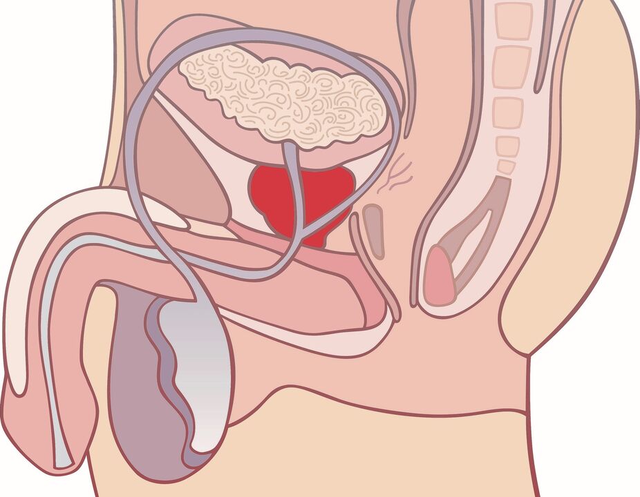 próstata inflamada con prostatitis